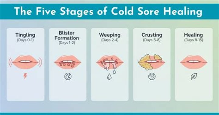 Does compeed heal cold sores?