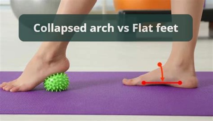 What is a collapsed foot?