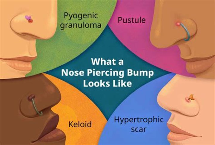 Why do I keep getting piercing bumps?